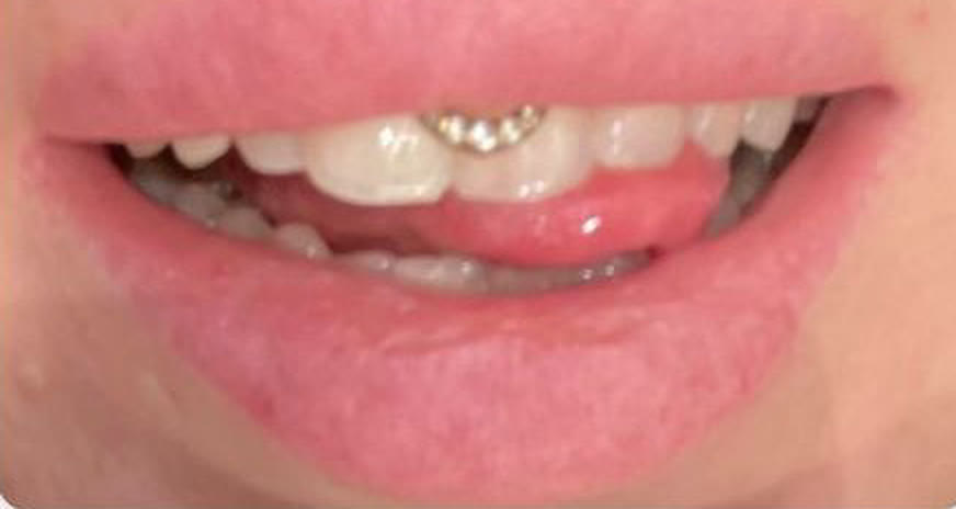 Jill's teeth photographed before the course