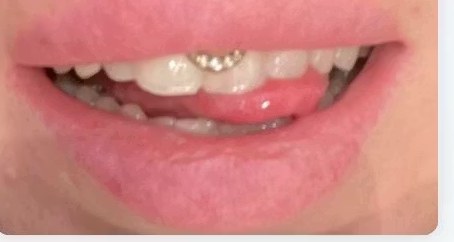 Jill Larsson's teeth before the whitening course
