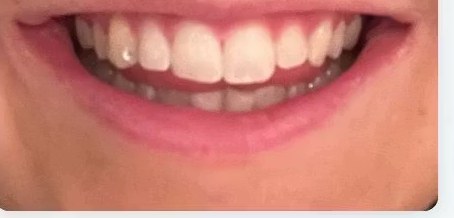 Mimi Cronquist's teeth before the whitening course