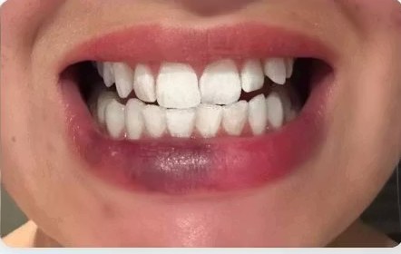 Wilda Bogren's teeth after the whitening course