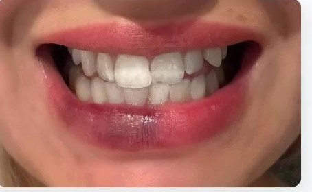 Wilda Bogren's teeth before the whitening course